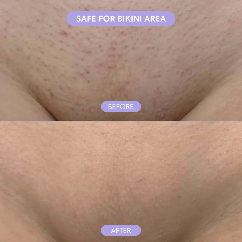 Body Hair Removal Cream