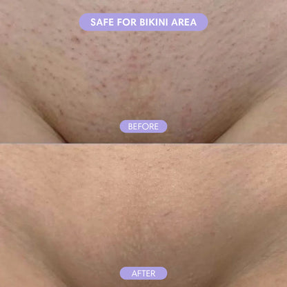 Body Hair Removal Cream